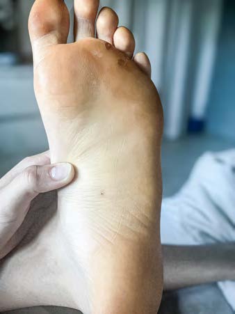 Close-up of a foot with a visible wound or lesion, held by a hand.