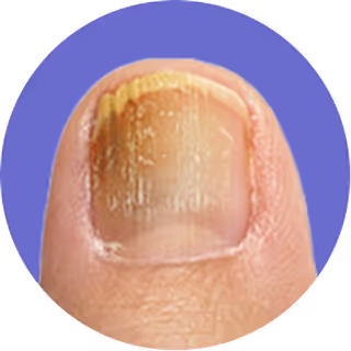 Nail with yellowish discoloration on a purple background